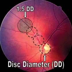 review of optometry handbook of ocular disease